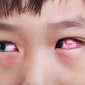 Bệnh đau mắt đỏ và các biện pháp phòng chống