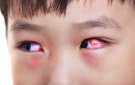 Bệnh đau mắt đỏ và các biện pháp phòng chống